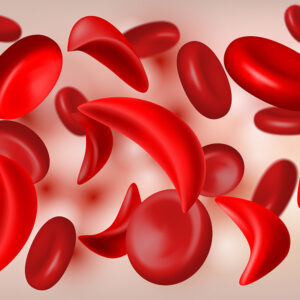 Cure Sickle Cell Disease by 2030?