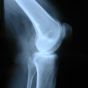 Got Healthy Bones? A New Test Can Answer That!