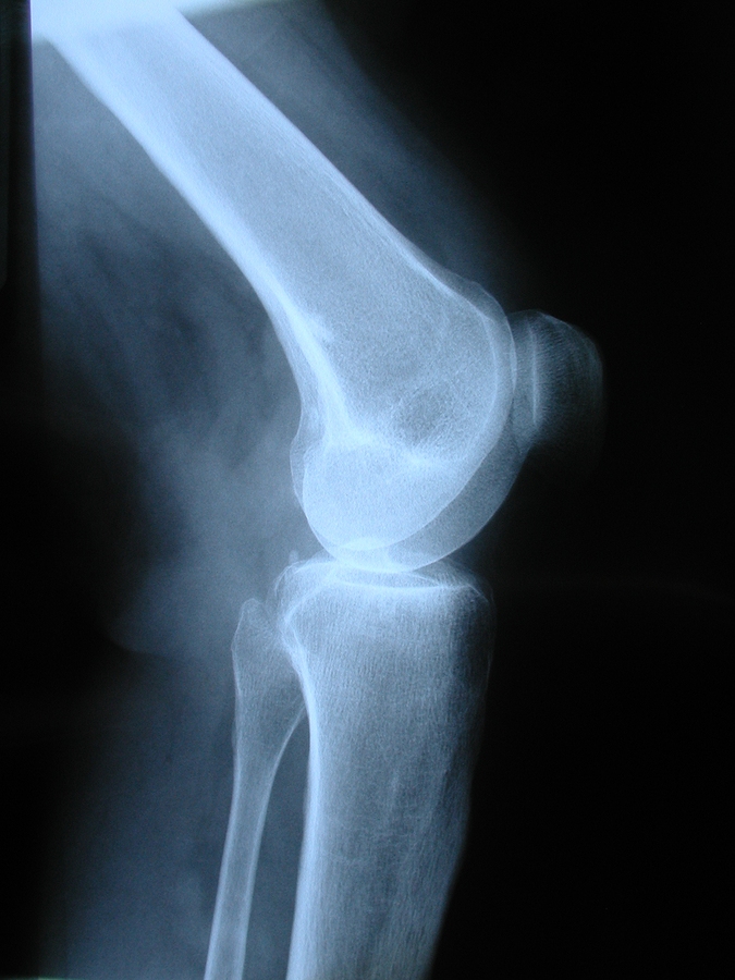 Got Healthy Bones? A New Test Can Answer That! – Dc Journal - Insidesources